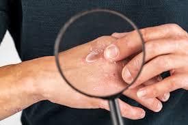 Técnicas Fisioterápicas De Avaliação Dermatológica