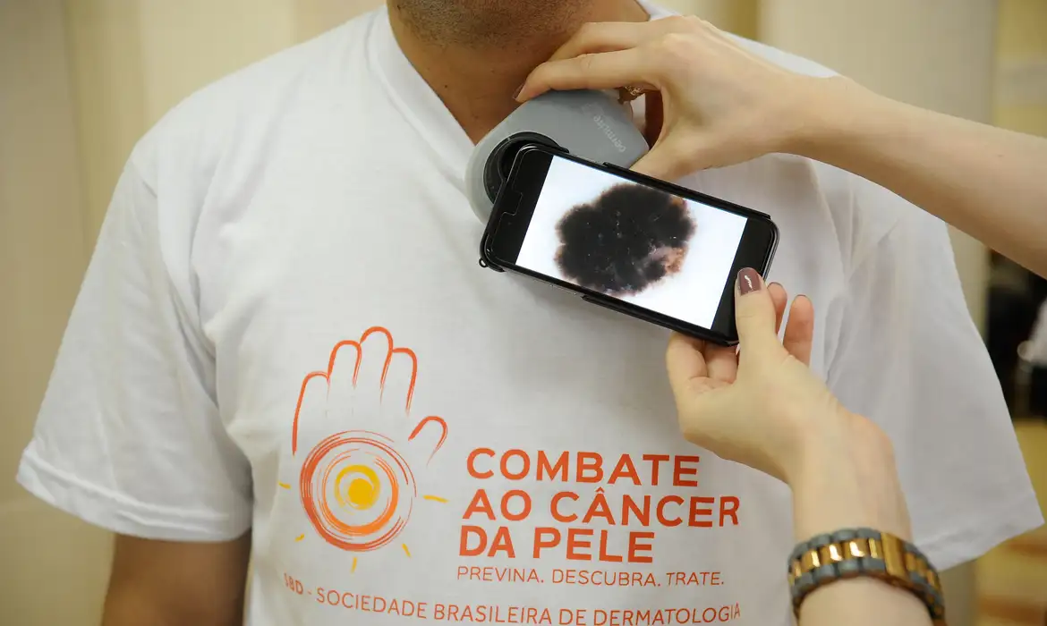 Exame para Diagnóstico de Câncer de Pele com Dermatoscópio Pessoa usando camiseta da Sociedade Brasileira de Dermatologia sendo examinada com dermatoscópio e celular mostrando lesão na pele